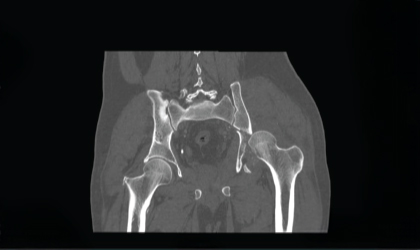 Fracture Fixation and Hip Replacement