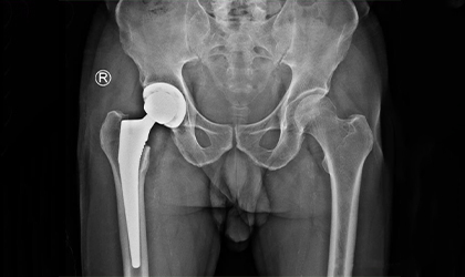 Hip Replacement Case Study