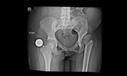 Knee Replacement Case Study